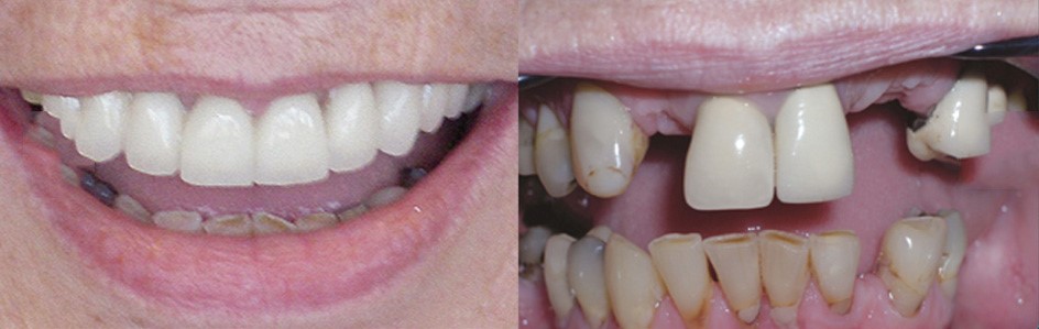 Before And After Dentures Nooksack WA 98276